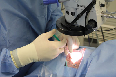 Intraoperative use of a self-illuminated intraoperative LED ring keratoscope (Illuminating Surgical Keratoscope, Mastel Precision) with fixation light to align a multifocal toric IOL to the target axis and line of sight. 