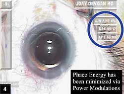 Figure 4: Phaco energy minimized via Power Modulations