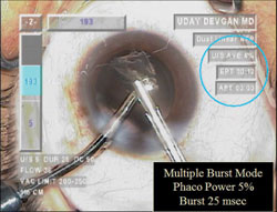 Minimizing phaco energy with burst mode