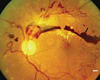 Fundus picture of Proliferative diabetic retinopathy