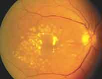 Fundus picture after macular lasers for diabetic macular edema