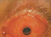 Appearance of eye at 1 month, after receiving superficial keratotomy