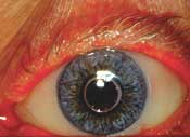 Appearance of eye with cosmetic scleral shell