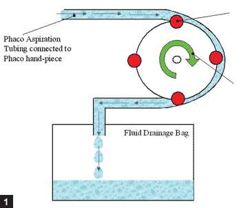 Figure 1:  The peristaltic pump uses rollers to compress the phaco outflow tubing in a peristaltic manner, thereby creating flow