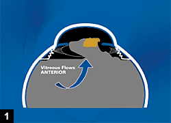 Figure 1: Low pressure in the anterior chamber causes a shallow anterior chamber, and higher pressure in the vitreous cavity causes vitreous prolapse