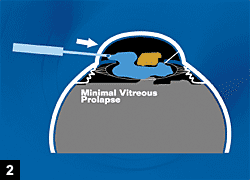 Figure 2: Higher pressure in the anterior chamber due to viscoelastic gives a deeper anterior chamber, equal or lower pressure in the vitreous