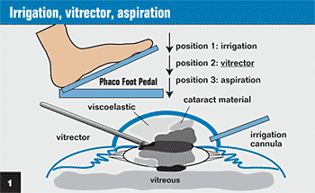 Figure 1:  Irrigation, vitrector, aspiration