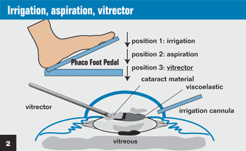 Figure 2:  Irrigation, aspiration, vitrector