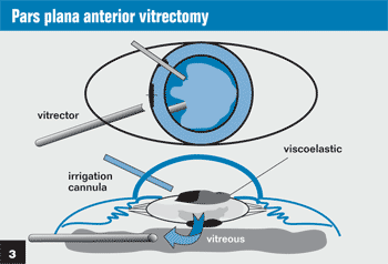 Figure 3: Pars plana anterior vitrectomy