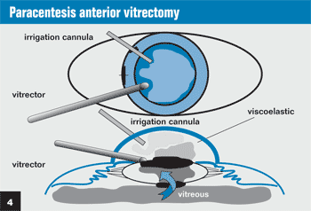 Figure 4:  Paracentesis anterior vitrectomy