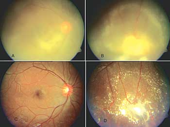 Fundus photograph R/E of a 15-year-old boy