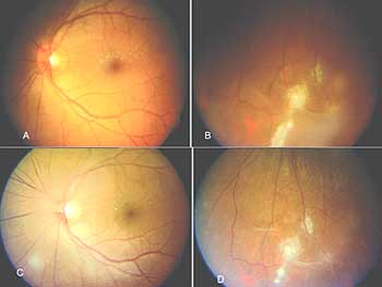 Left eye of same patient showing media haze due to vitritis