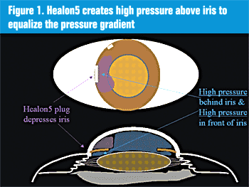 Figure 1. Healon 5 creates high pressure above iris to equalize the pressure gradient