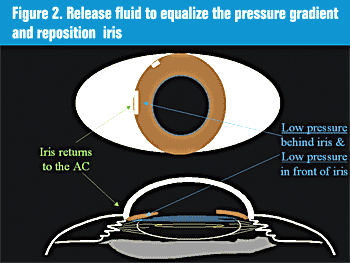 Figure 2: Release fluid to equalize the pressure gradient and reposition iris