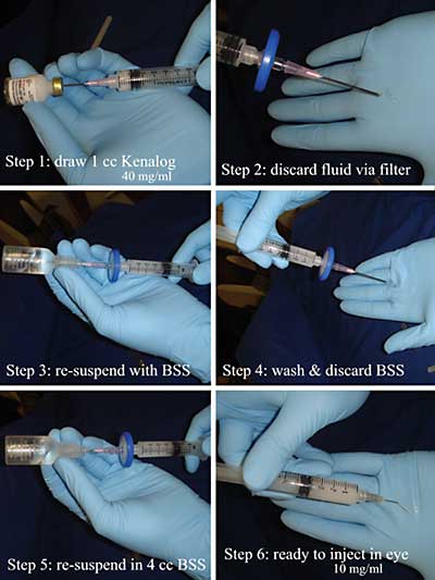 Instructions for preparation of triamcinolone for intraocular use