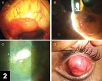 Figure 2: Gelatinous OSSN (A), Papilliform OSSN (B), Leukoplakic OSSN (C), Nodular OSSN (D)