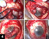 Figure 4: Lamellar dissection