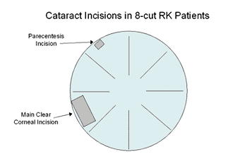 Cataract incisions in 8-cut RK patients