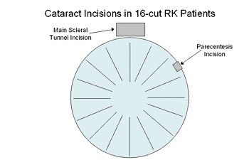 Cataract incisions in 16-cut RK patients