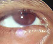 One symptom in some dry eye patients is discharge