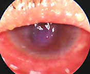 Allergic conjuctivitis is one of the conditions commonly seen in Dr. Maskati’s office