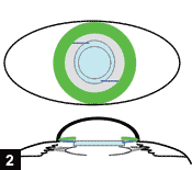 Figure 2: The IOL optic and haptics are placed in ciliary sulcus