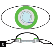 Figure 3: The IOL haptics are placed in the ciliary sulcus, while the optic is captured behind the intact anterior capsulorrhexis