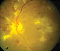 Left eye of a patient with type 2 diabetes who presented with macular edema and severe nonproliferative diabetic retinopathy