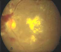 The same eye 6 weeks later shows foveal migration of the hard exudates