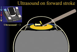 Figure 1. To emulsify the cataract