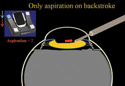 Figure 2. When retracting the phaco probe