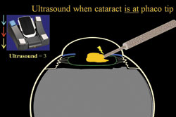 Figure 4. Once the cataract piece is right at the phaco tip