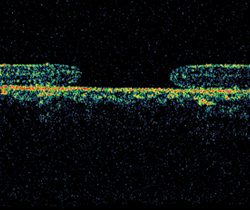 Figura 2. OCT que muestra un hoyo macular.