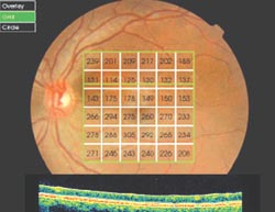 Figura 1. Retinografía del fundus del ojo izquierdo