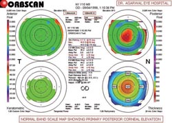 Figura 2. Los cuatro mapas con el filtro de escala de banda normal activado en el mismo ojo que la Figura 1. 