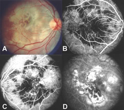 Figura 1. Epiteliopatia aguda de pigmento placoide multifocal posterior.