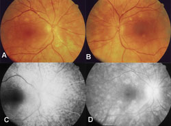 Figura 3. Coriorretinopatia do tipo "Birdshot".