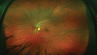 Figure 2. Wide-field color image of the left eye fundus 