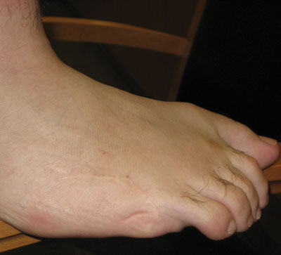 Figure 1. The patient had a sixth toe on each foot surgically removed as a toddler.