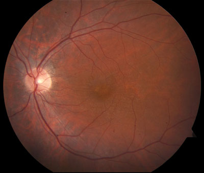 Figure 2. Color fundus photograph showed mottling 