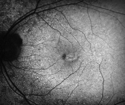 Figure 3. Fundus autofluorescence imaging disclosed mottled macular hyper- and hypo-autofluorescence.