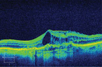 Baseline. BCVA: 20/63 +1. Protocol anti-VEGF injection. 24 Gy brachytherapy.