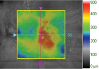 Baseline. BCVA: 20/63 +1. Protocol anti-VEGF injection. 24 Gy brachytherapy.