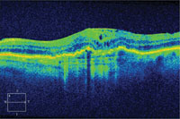 30-day  follow-up. BCVA: 20/63 +2 (+1 ETDRS letter). Protocol anti-VEGF injection.