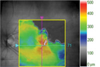 30-day  follow-up. BCVA: 20/63 +2 (+1 ETDRS letter). Protocol anti-VEGF injection.