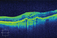 60-day follow-up. BCVA:  20/63 +2 (+1 ETDRS letter). No anti-VEGF injection.