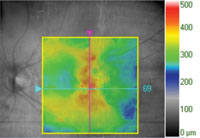 60-day follow-up. BCVA:  20/63 +2 (+1 ETDRS letter). No anti-VEGF injection.