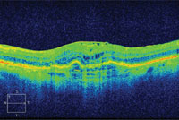 90-day follow-up. BCVA: 20/50 -1 (+ 3 ETDRS letters). No anti-VEGF injection.