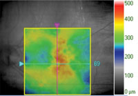 90-day follow-up. BCVA: 20/50 -1 (+ 3 ETDRS letters). No anti-VEGF injection.