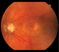 Both images (right and left) show the patient at baseline after at least 11 previous injections and before initiation of the study treatment (brachytherapy).